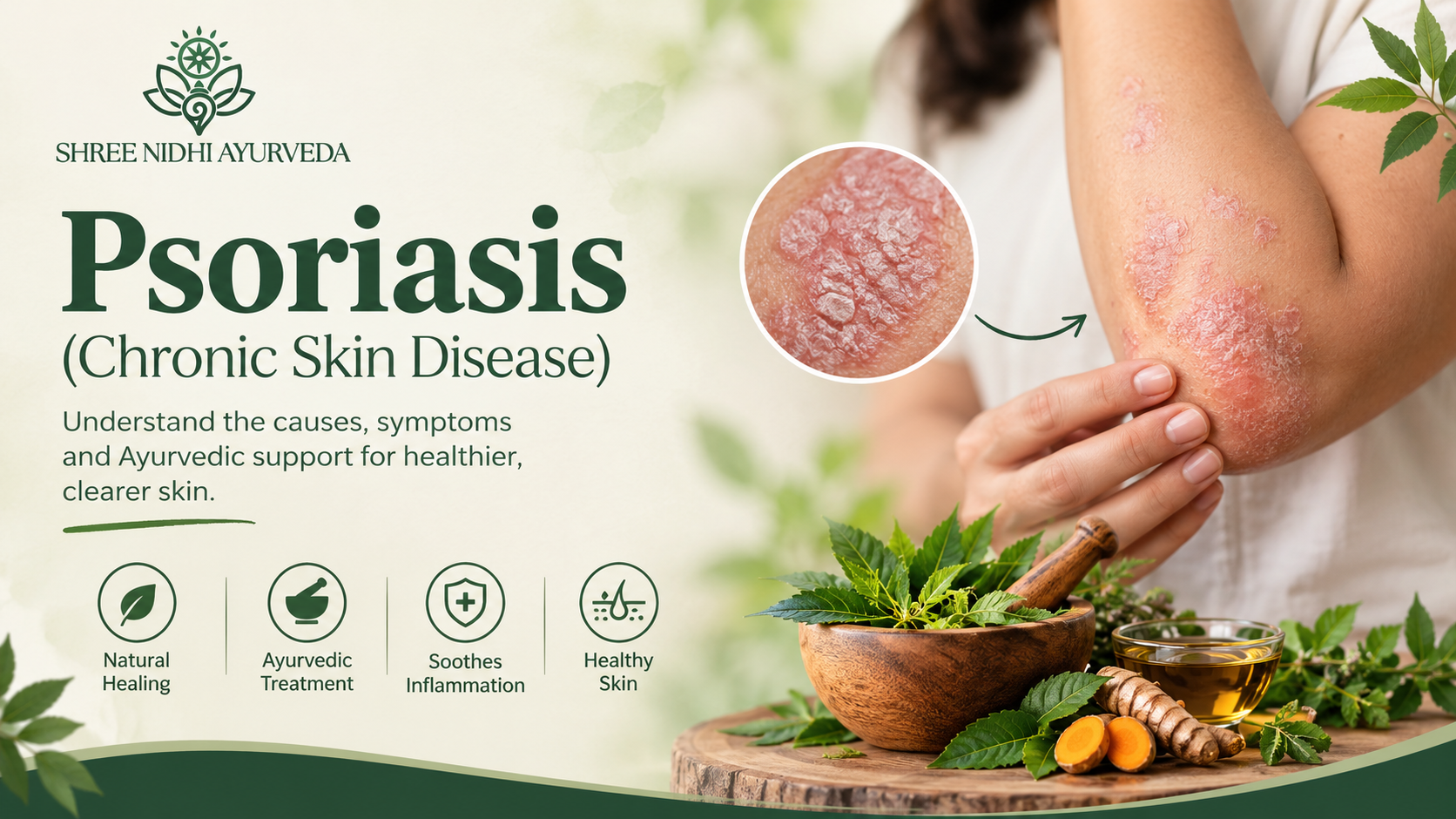Psoriasis: Causes, Symptoms, Skin Care and the Ayurvedic Approach